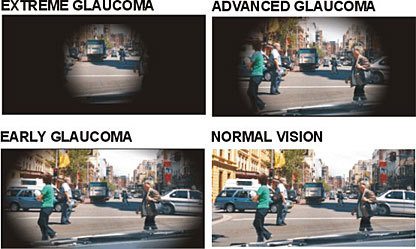 Tunnel Vision (Peripheral Vision Loss): Causes & Treatment