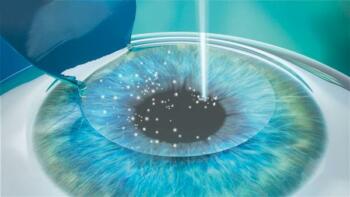 Laser correcting refractive errors in an eyeball