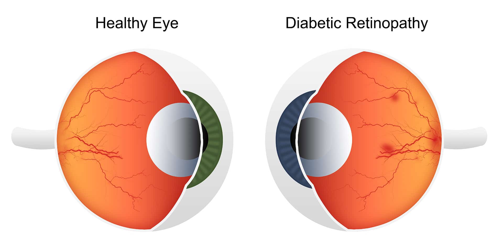 Diabetic Retinopathy Eye