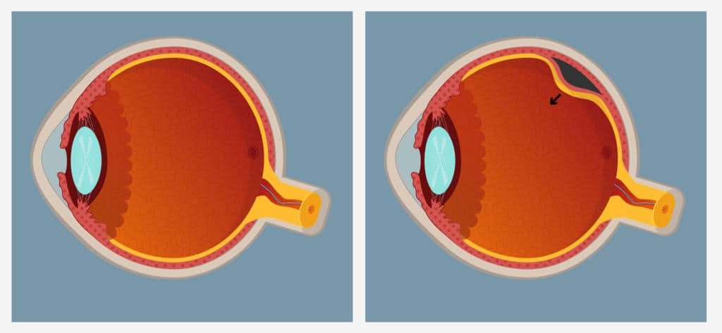 normal retina