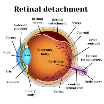 retinal detachment treatment