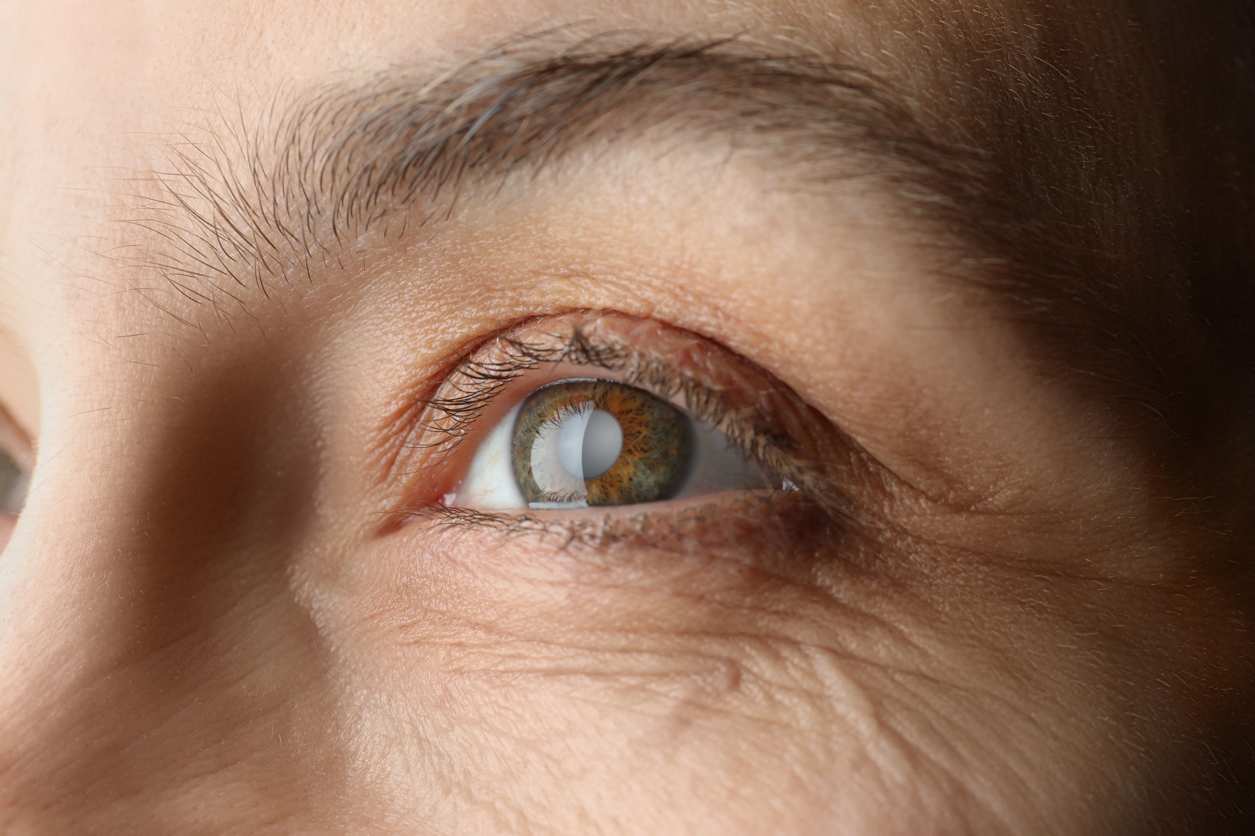 A Step-by-Step Guide to Cataract Post-op Care