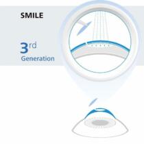 SMILE Eye Surgery Graphic