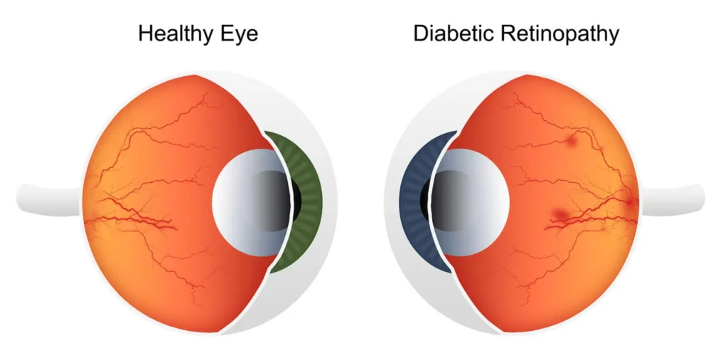 diabetic retinopathy .jpg
