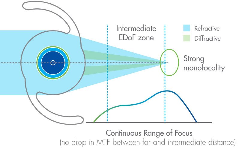 Diagram of an extended depth of focus (EDOF) intraocular lens