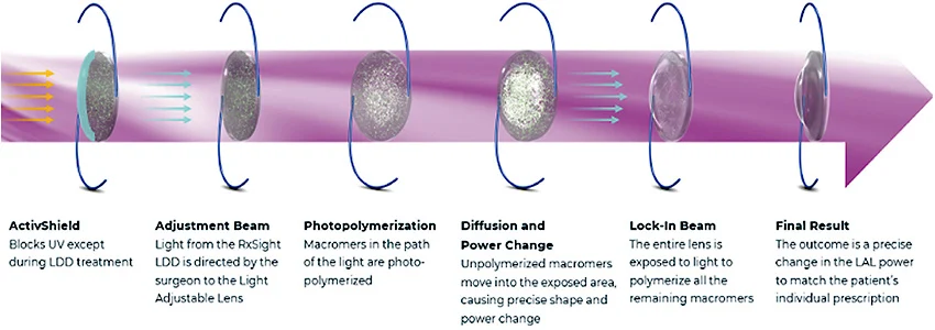 RxSight Light Adjustable Lens LAL and LAL+ step by step procedure