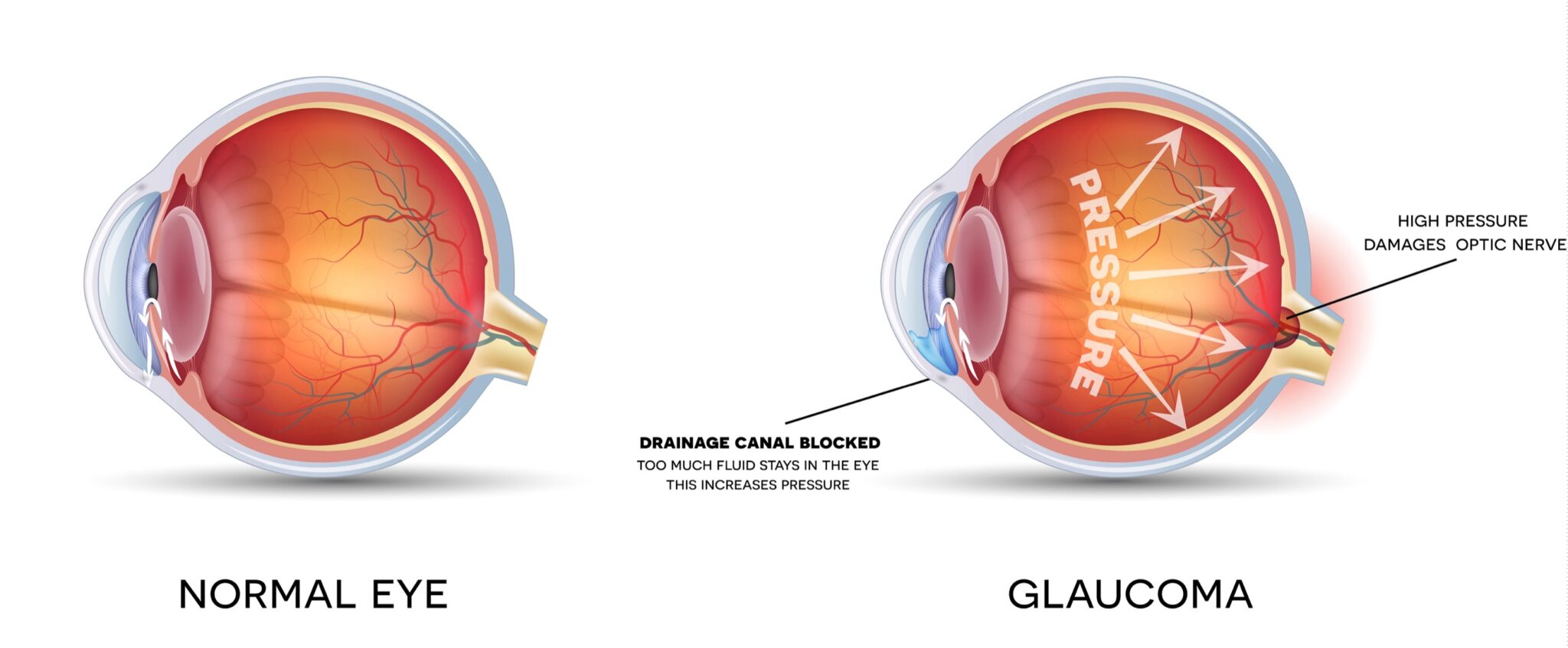 Glaucoma and healthy eye detailed structure.